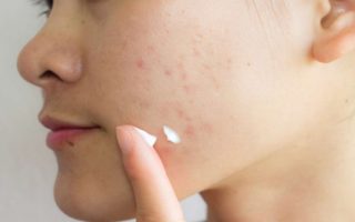 How to treat Acne Scar at Home