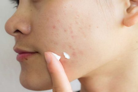 How to treat Acne Scar at Home