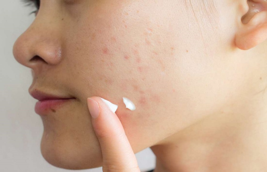 How to treat Acne Scar at Home