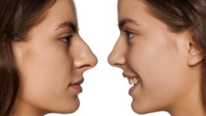 nose job surgery