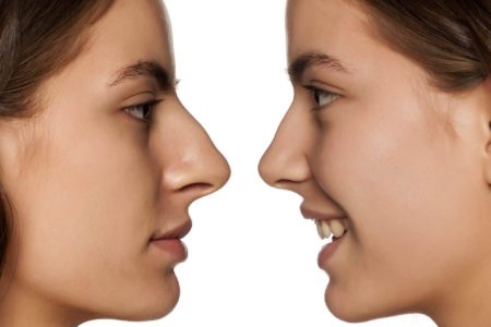 nose job surgery