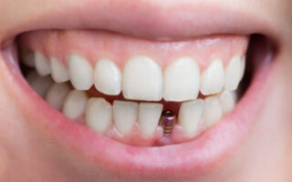 Dental Implants