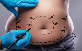 CoolSculpting