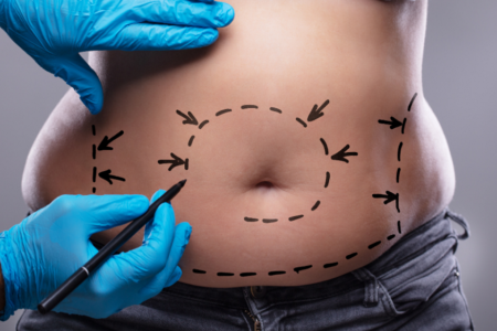 CoolSculpting