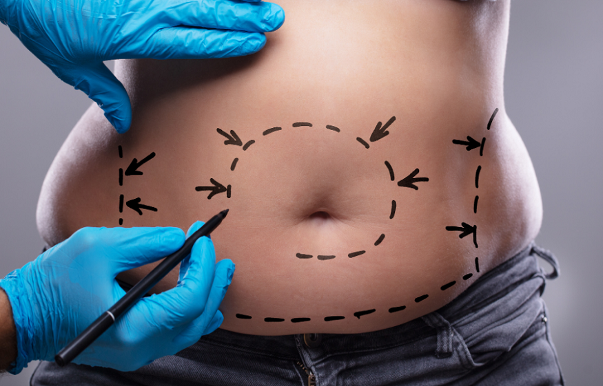 CoolSculpting